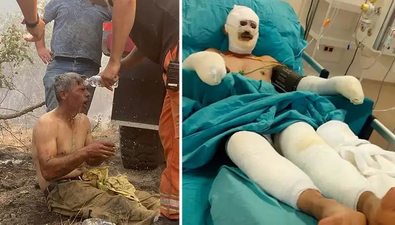 Yanıyorum Diyen Orman İşçisinin Hayatı Tehlikede, Tedavi Süreci Devam Ediyor